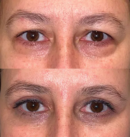 Pálpebras antes e depois da blefaroplastia
